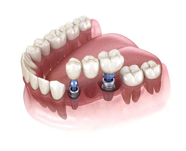 A 3d illustration of the lower jaw showing the abutment, post, and crown of a dental implant