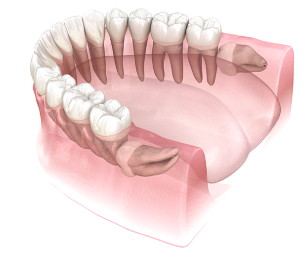 A 3d illustration of the lower jaw showing an x-ray view of the gum line with wisdom teeth visible